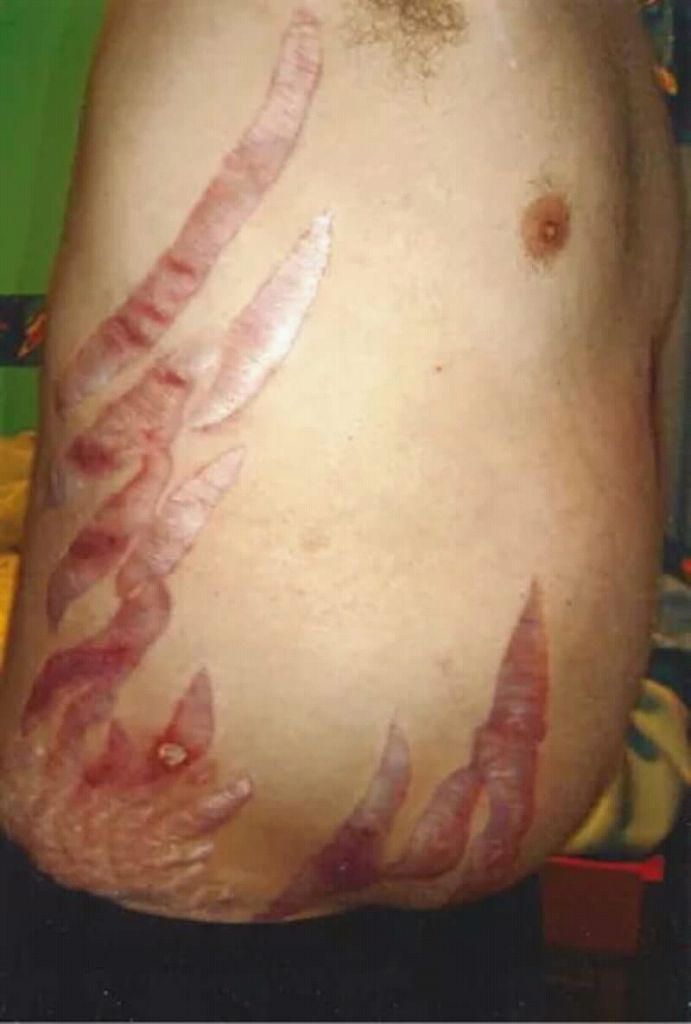 La malaltia de Cushing és deguda a un excés de producció de corticotropina (Imatge: wikimedia).