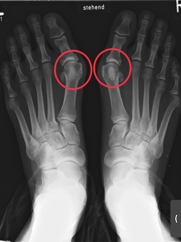 Rediografia d'uns peus amb galindons.