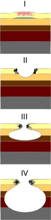 Estadificació de l'úlcera/-150 Estadificació de l'úlcera/-150