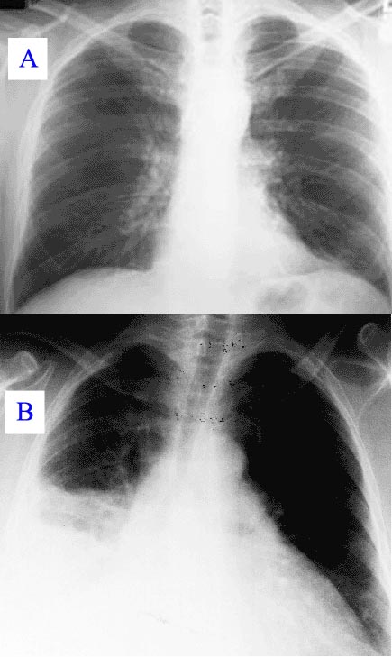 La pneumònia vista per radiografia: radiografia toràcica normal (A) i anormal (B), amb opacitat per pneumònia al pulmó dret (àrea blanca, costat esquerre de la imatge)./-60