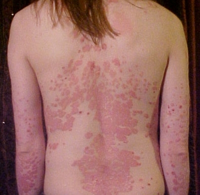 La psoriasi pot provocar en alguns casos una afectació important de la imatge corporal i causar una gran inseguretat en la persona afectada, i també actuar com a estigma que interfereix en les relacions socials. Font: The Wednesday Island (Wikimedia Commons)./-22