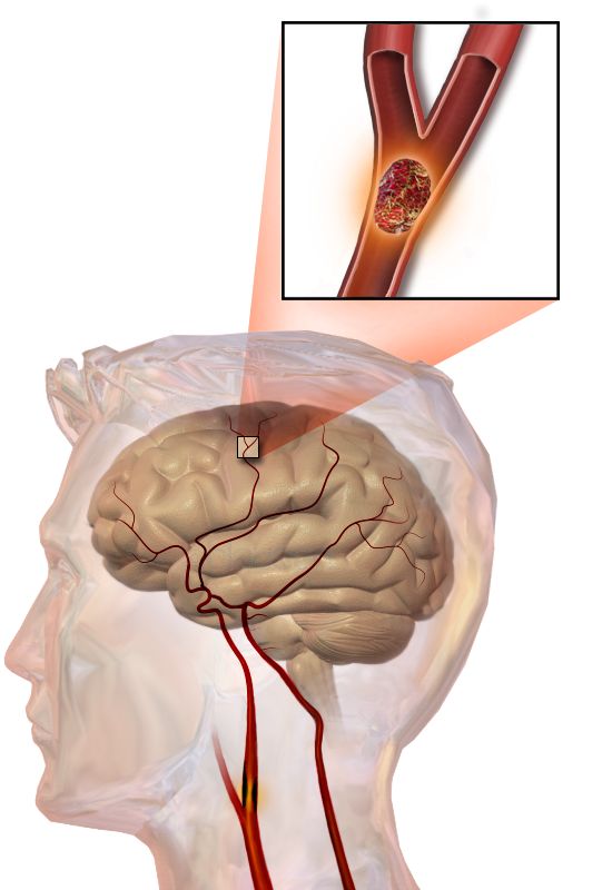 Il·lustració d'una embòlia cerebral/-40 Il·lustració d'una embòlia cerebral/-40
