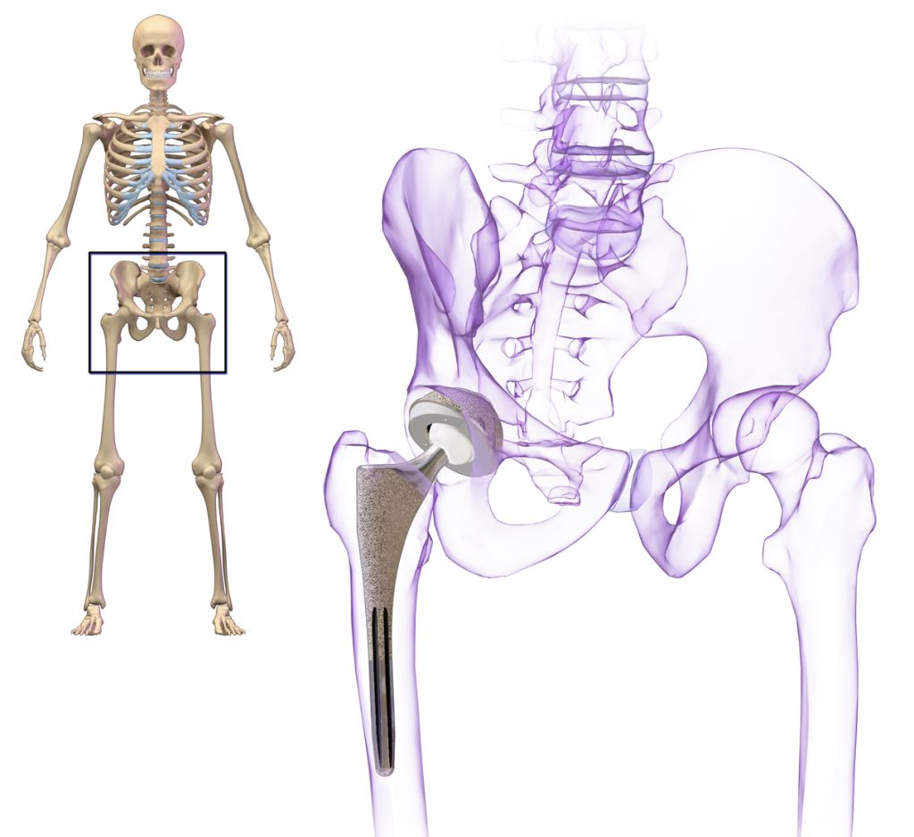 Pròtesi de maluc dret. Font: Wikimedia Commons.