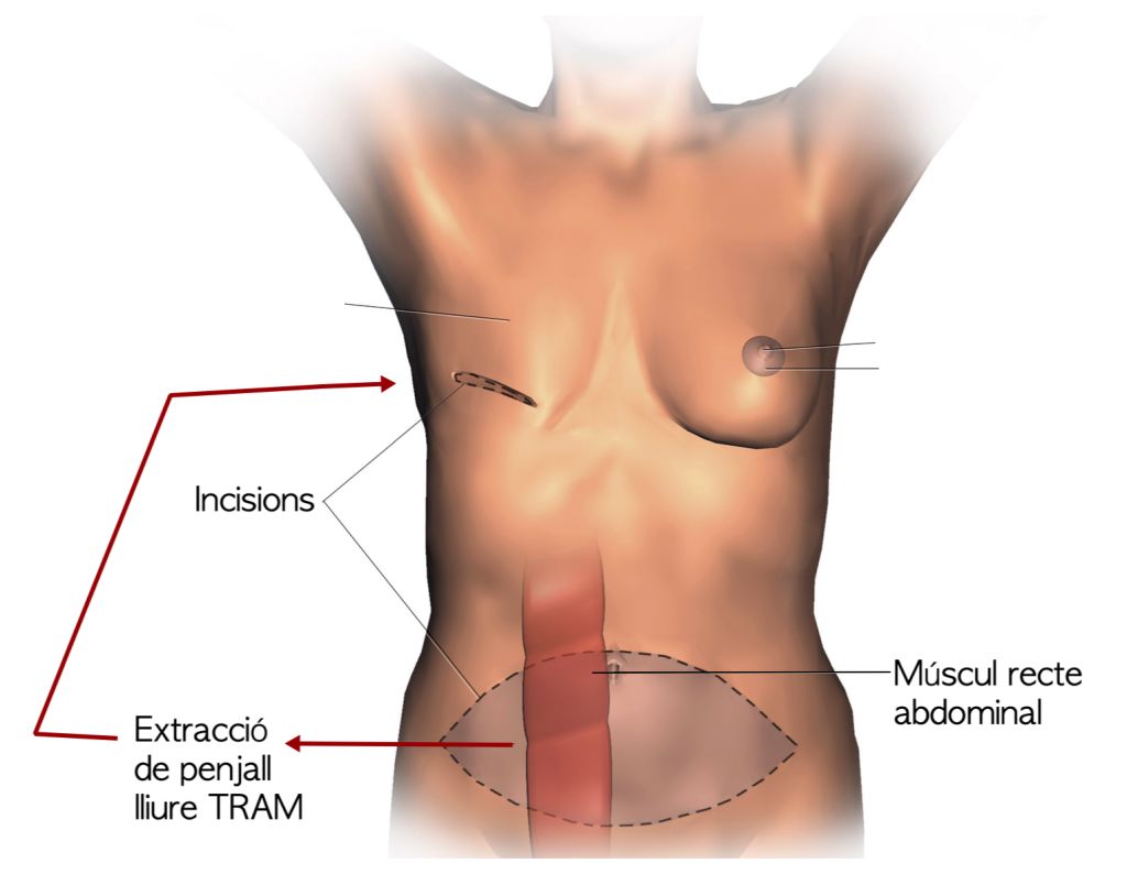 Reconstrucció mamària amb penjall lliure TRAM. Font: Wikimedia Commons, modificada.