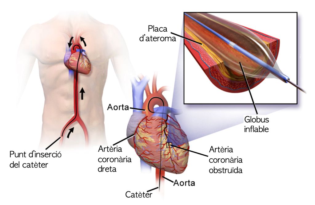 Angioplàstia coronària transluminal percutània. Font: Wikimedia Commons, modificada.