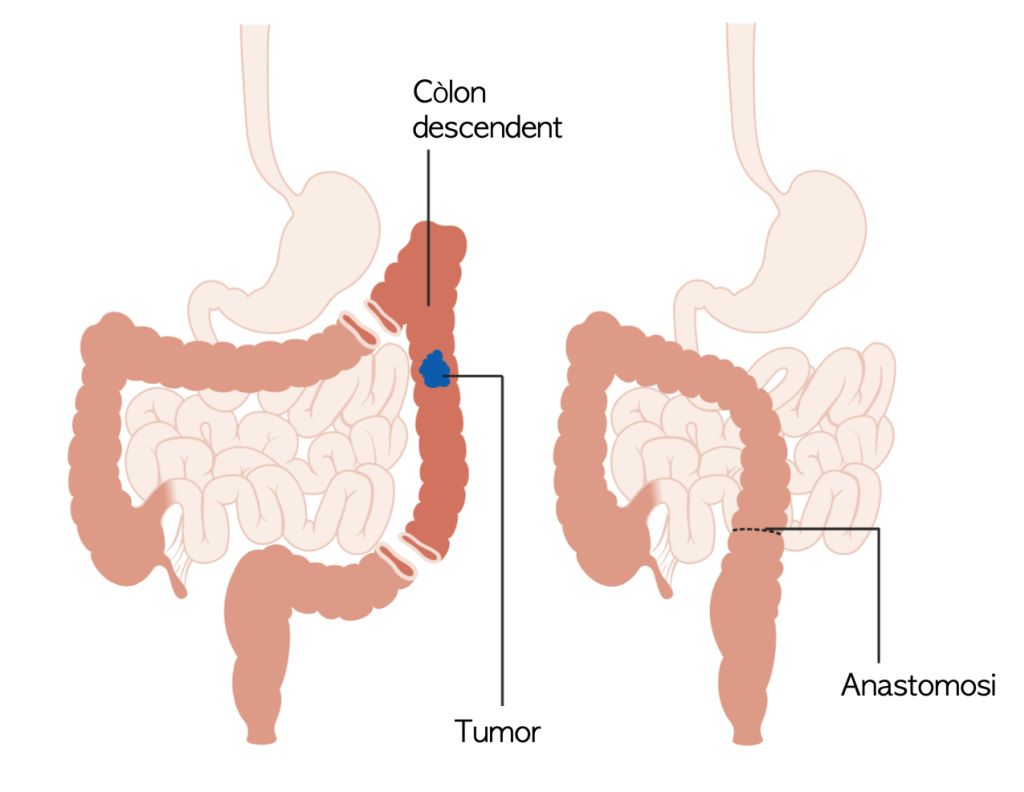 Hemicolectomia esquerra i anastomosi colorectal. Font: Wikimedia Commons, modificada.
