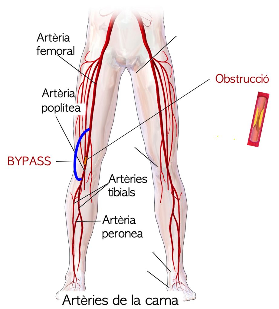 Bypass femoropopliti. Font: Wikimedia Commons, modificada.