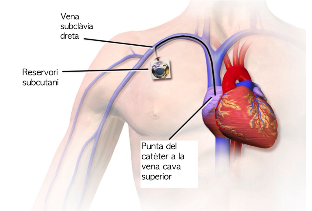 Inserció de Port-a-Cath. Font: Wikimedia Commons, modificada.