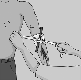 Usar el torniquet únicament està justificat, si hi ha algun membre seccionat o amputat o la distància al centre hospitalari és molt gran.