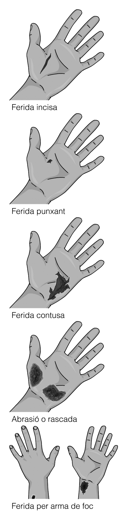 Esquemes de l'aspecte dels diferents tipus de ferides.