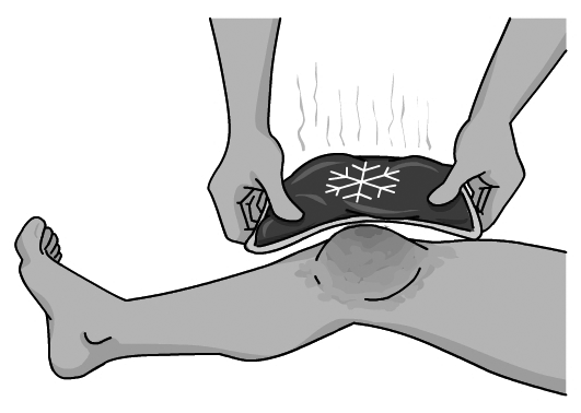 Posant un bloc de fred sobre un genoll contús.