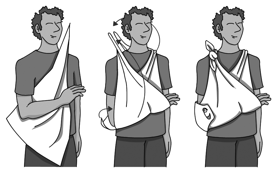 Col·locació d'un cabestrell. Passos per fer un cabestrell amb un mocador de coll.